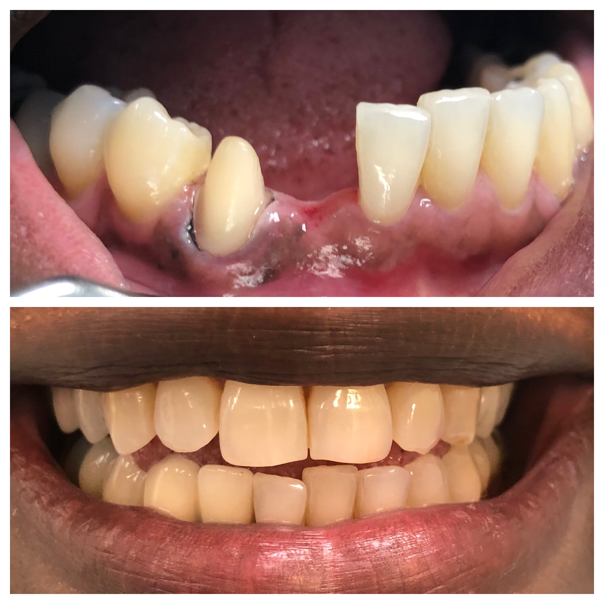 Dental bridge restoration