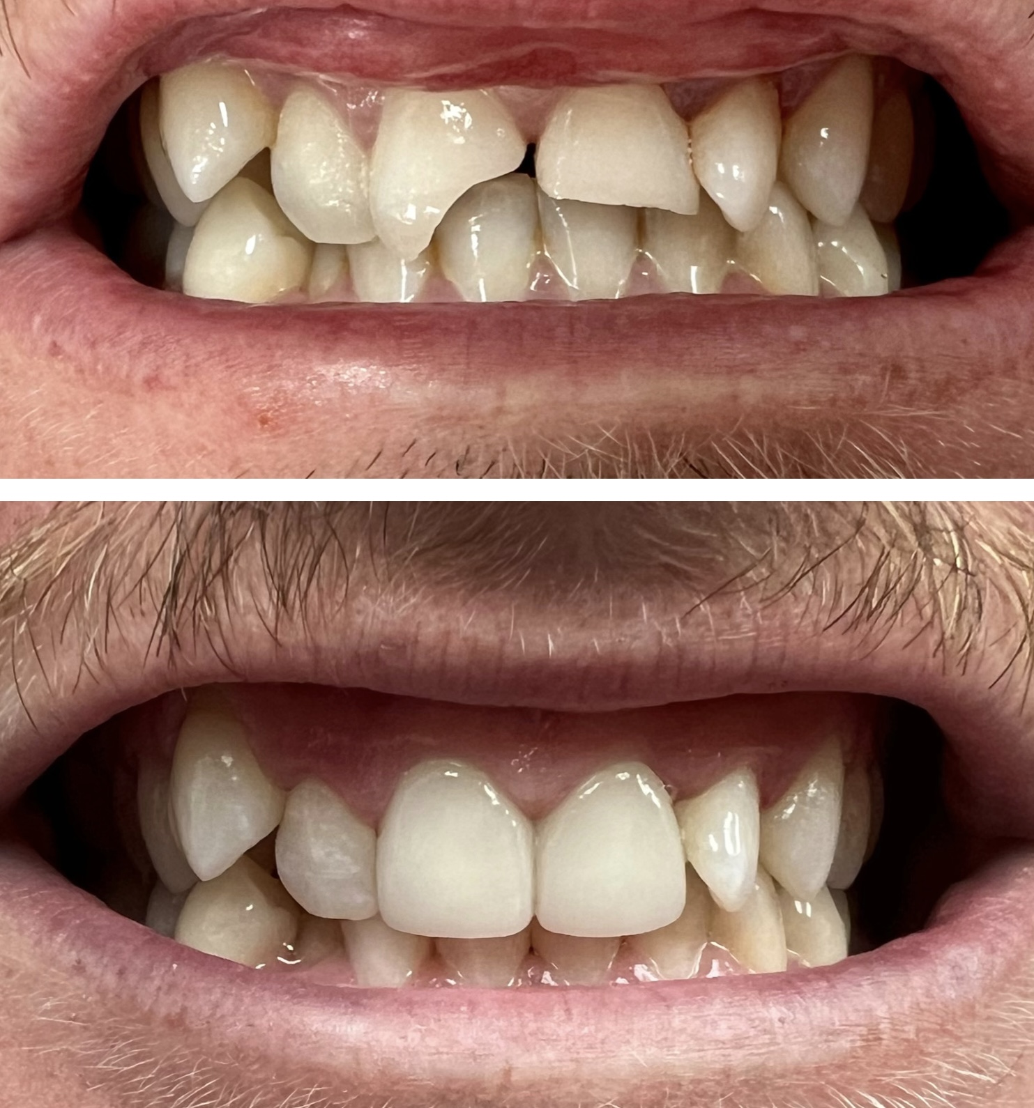 Dental crown restoration
