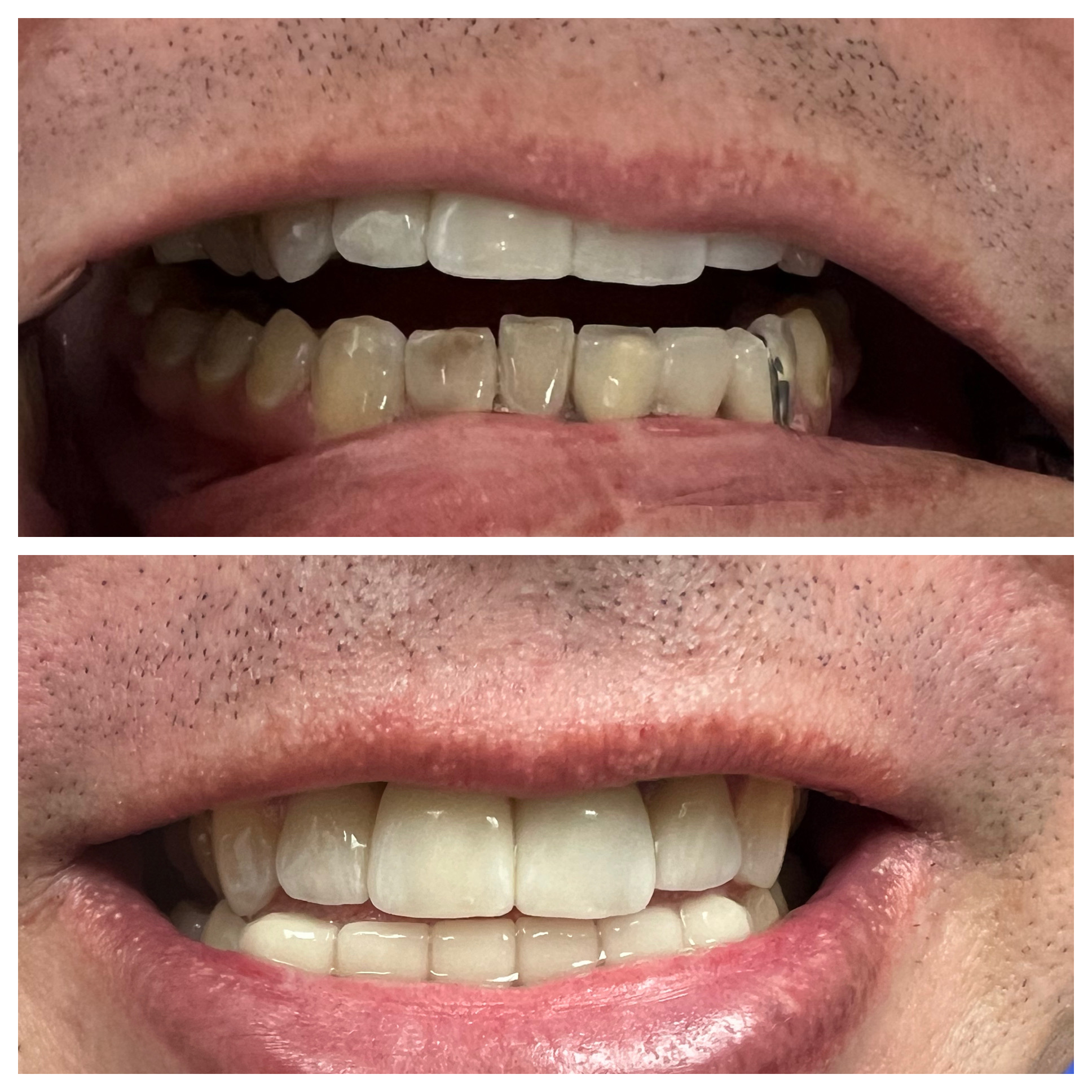 Dental crown restoration results