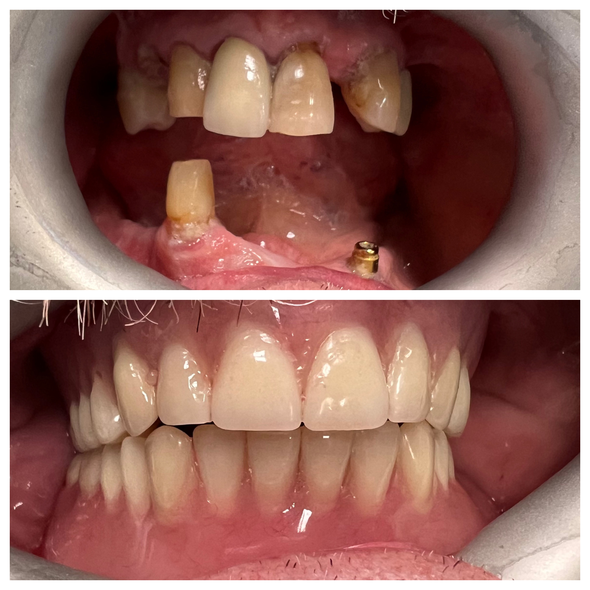 Tooth extraction and denture results