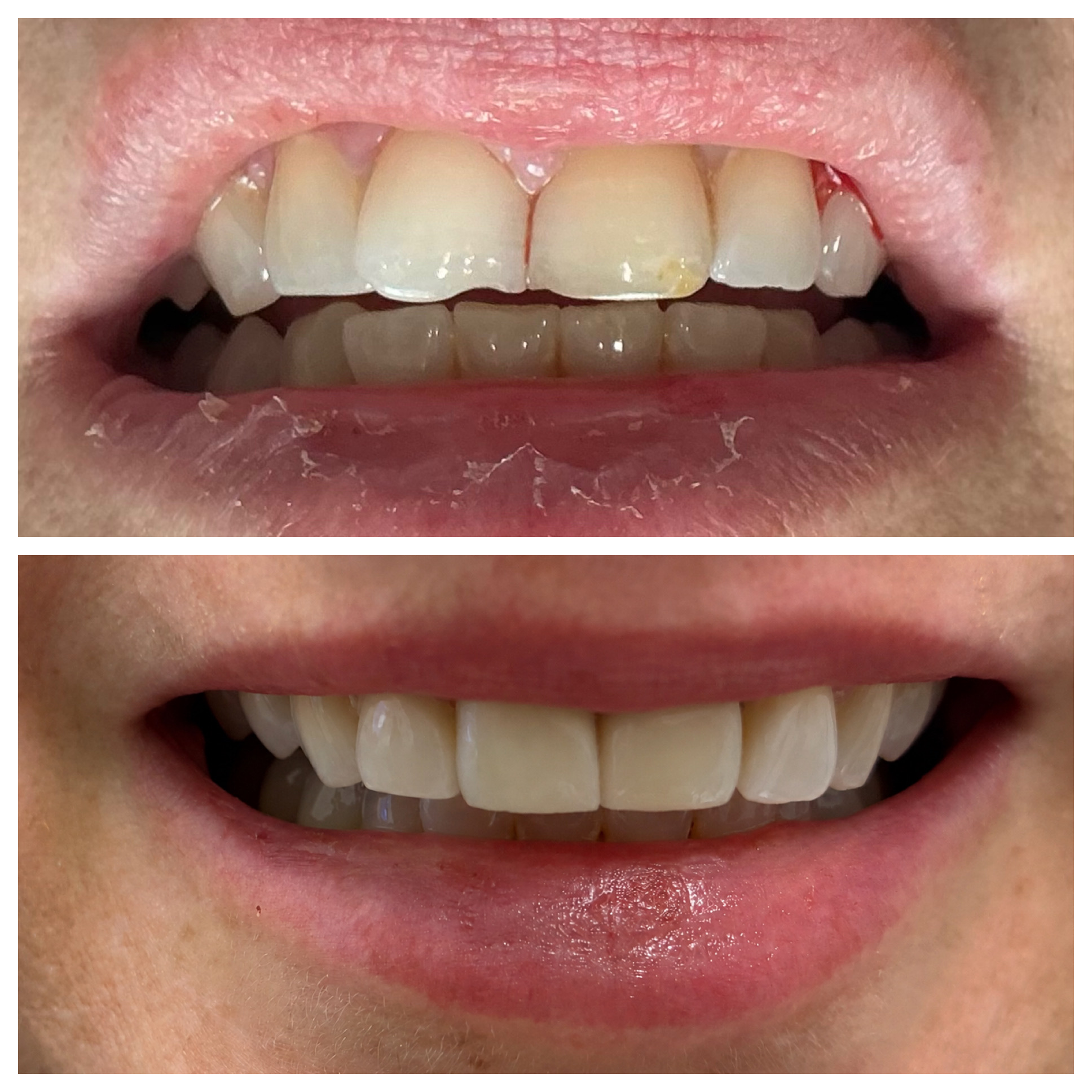 Front tooth crown restoration