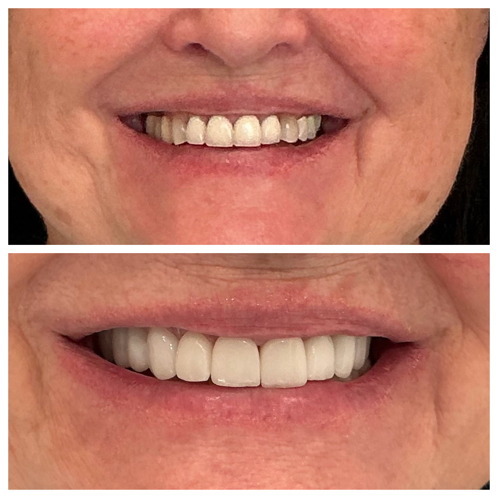 Smile design with dental crowns