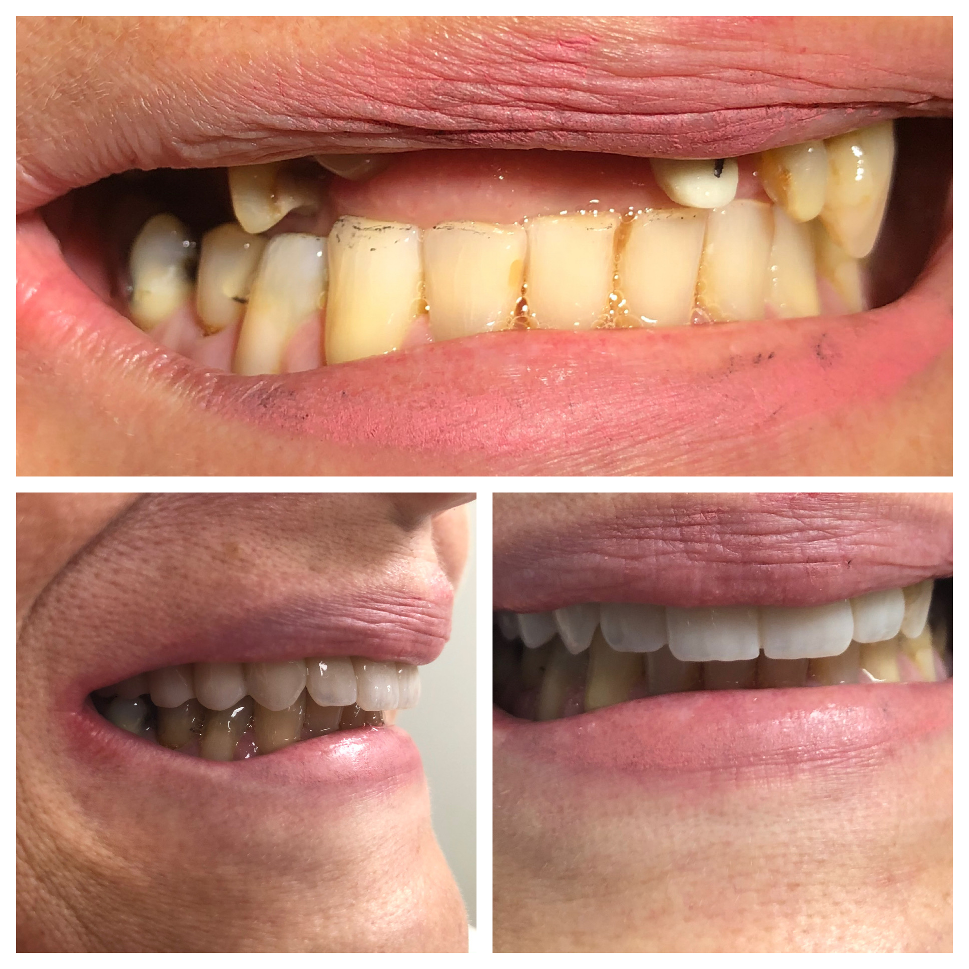 Upper denture fitting results