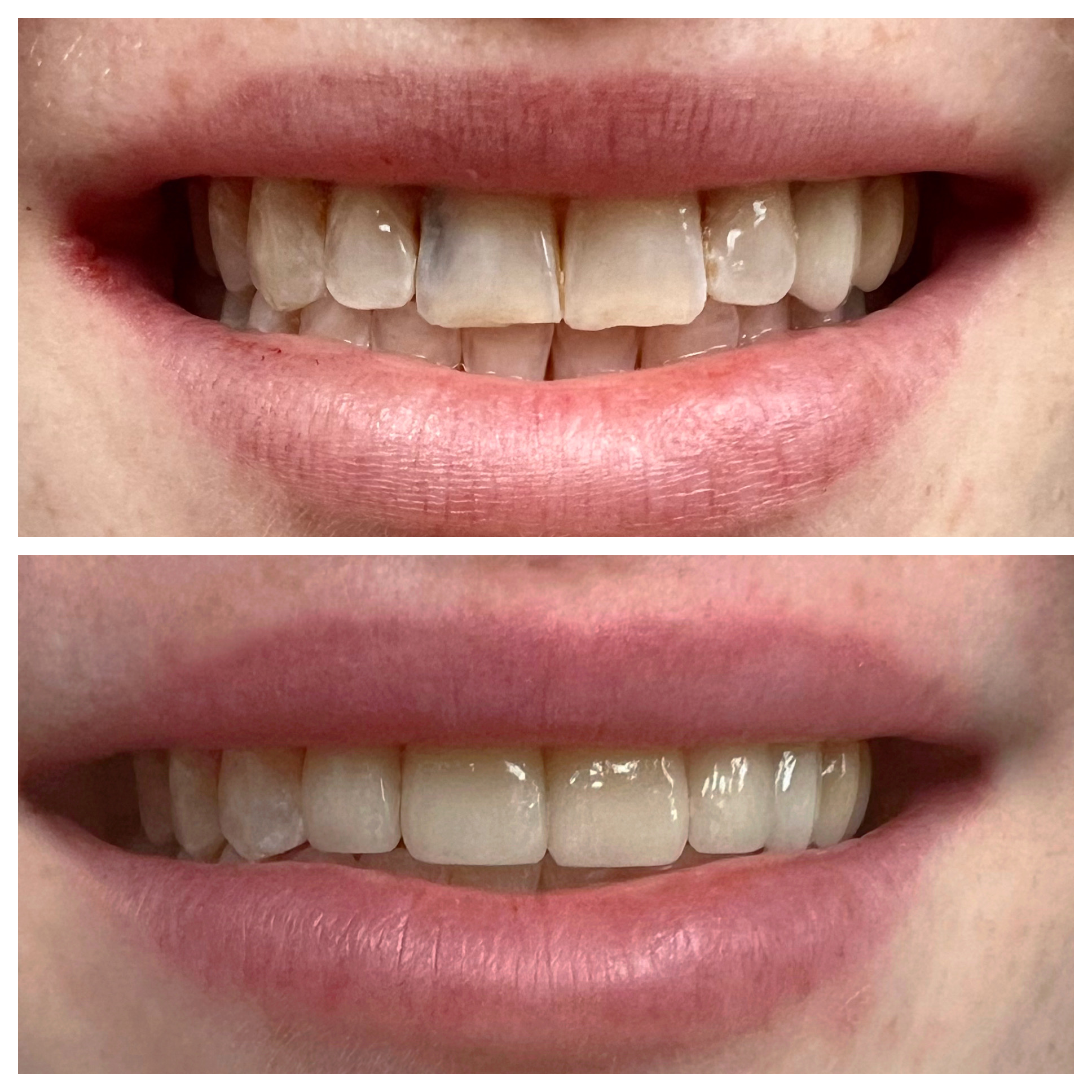 Dental crown treatment