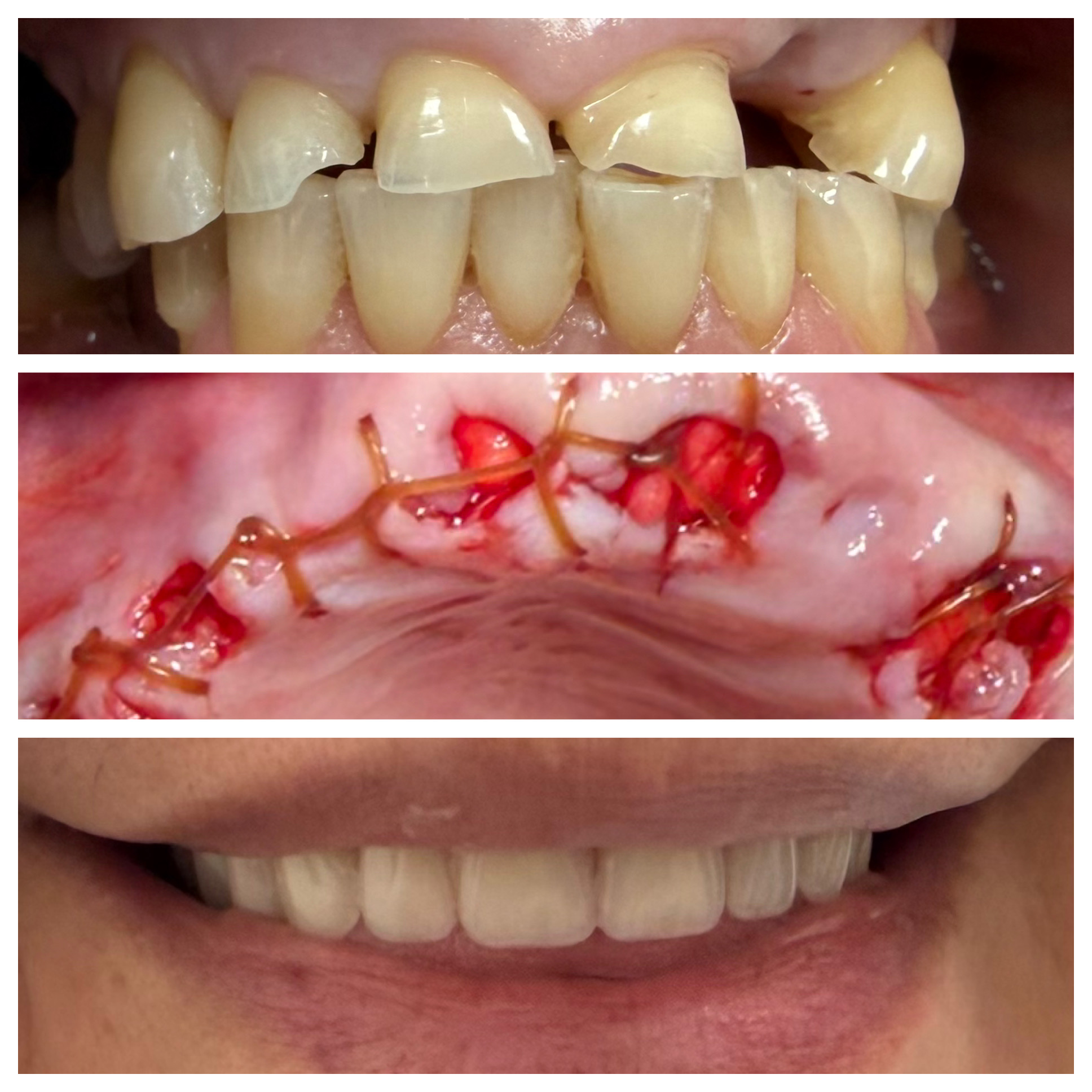 Tooth extraction and denture results