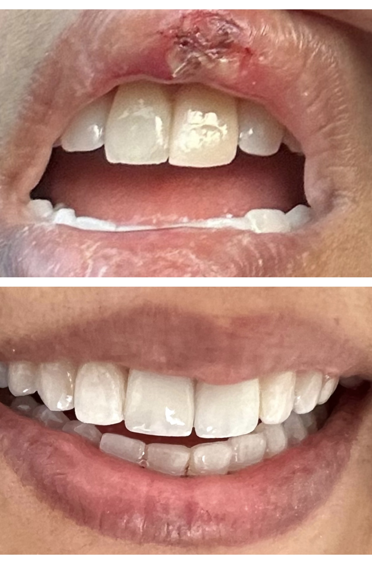 Lip repair and crown restoration after fall